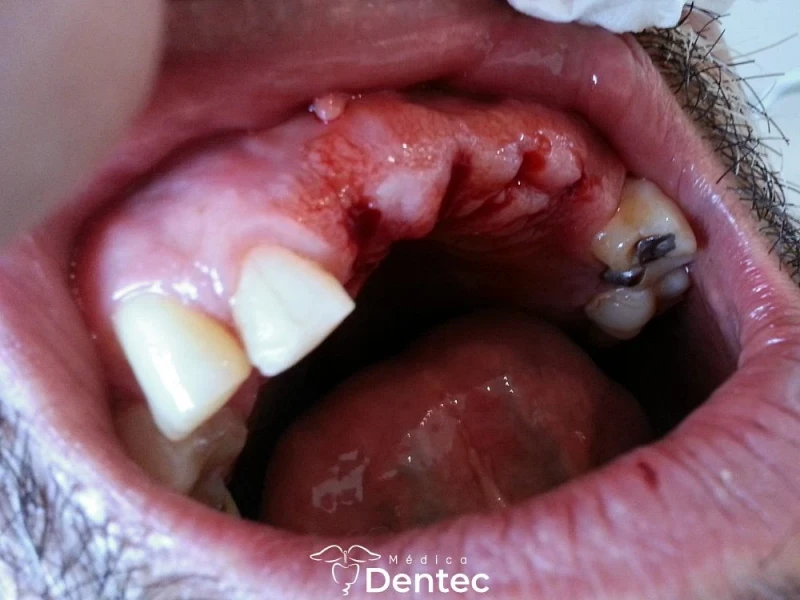 Rehabilitación con corona de zirconia — antes
