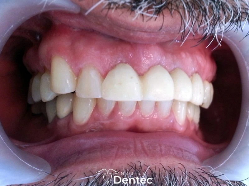 Rehabilitación con corona de zirconia — después