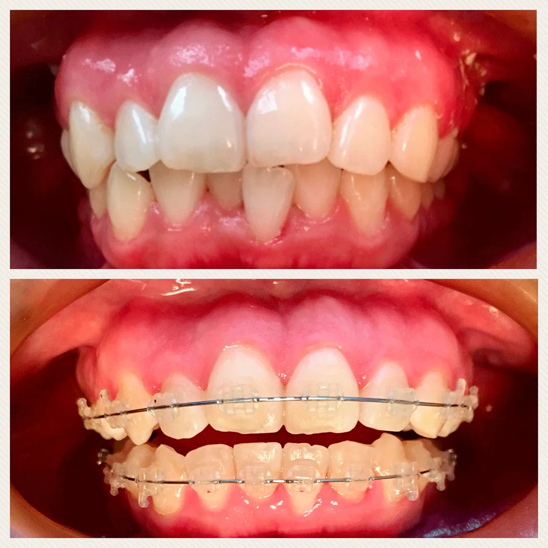Antes y después de ortodoncia
