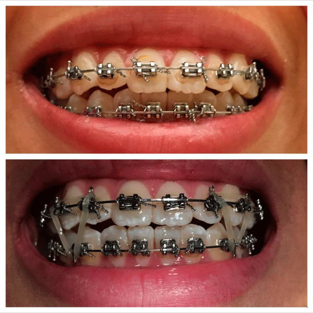 Antes y después de ortodoncia con brackets