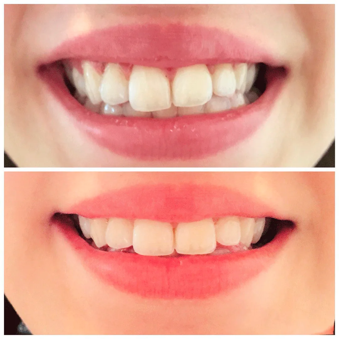 Antes y después de una sonrisa con estética dental