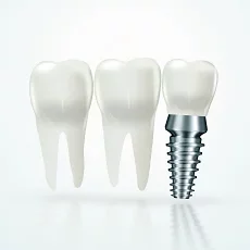 Especialidad Implantes Dentales